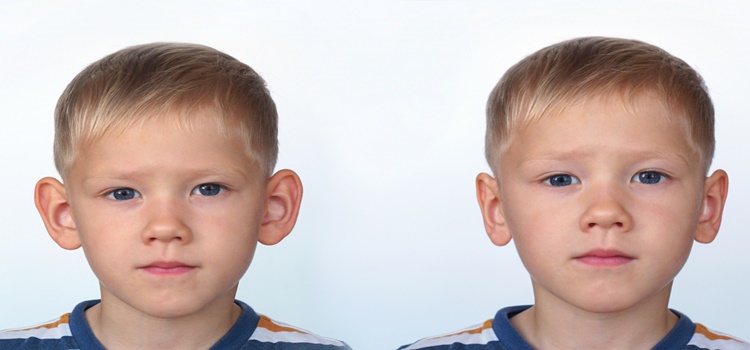 Çocuklarda Kepçe Kulak Sorunu Nedenleri ve Tedavisi