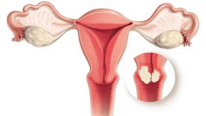 Rahim Ağzı Kanseri Nedir? Tedavisi Nasıl Olur?