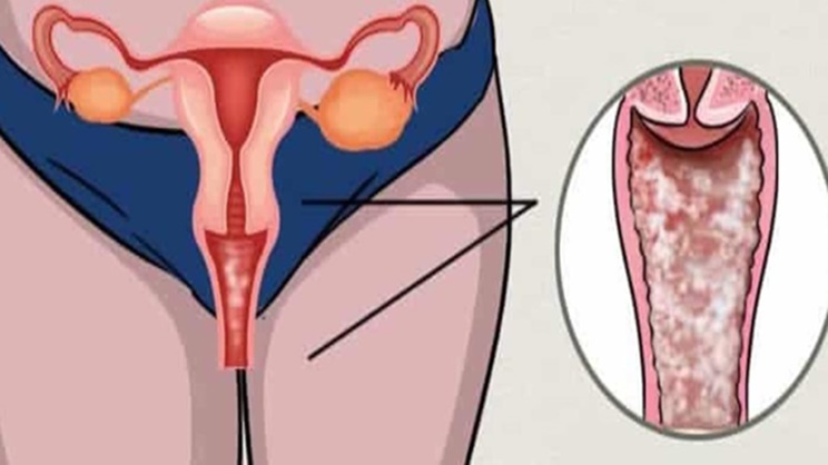 Vajinal Mantar Nedir?