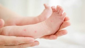 Bebeklerde Sinek Isırığı ve Kaşıntısı Nasıl Geçer?