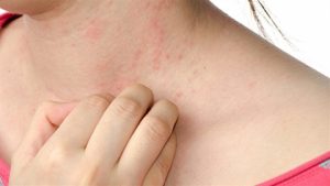 İsilik Oluşumunun Sebepleri Nelerdir? İsilik Nasıl Geçer?