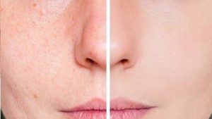 Yüzdeki Kırmızı Lekeler Nasıl Geçer? 