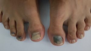 Ayak Tırnakları Neden Morarır?