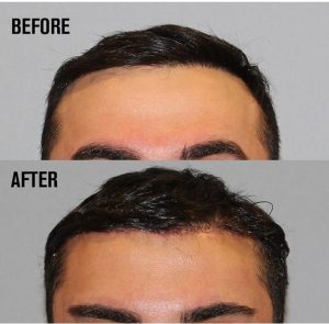 Düşük Kaşlara Kaş Kaldırma Estetiği İle Elveda Deyin!