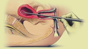 Kürtaj Ameliyatı Kaç Dakika Sürer?