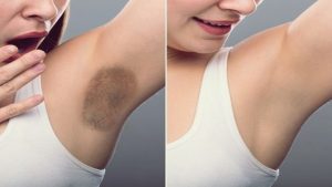 Koltuk Altı Neden Kararır? Nasıl Geçer?  