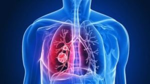 Bronşit Nedir? Neden Olur?