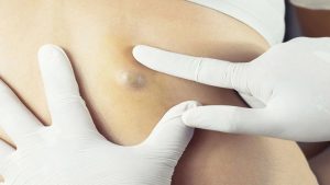 Yağ Bezesi için Hangi Doktora Gidilir?