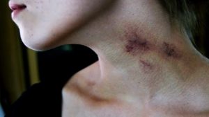 Boyundaki Morluk Nasıl Geçer? 