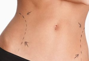 Liposuction Nedir? Yöntemleri Nelerdir?