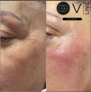 Kolajen İp Uygulamaları: Cilt Kırışıklıklarını Gidermek İçin Yenilikçi Bir Çözüm