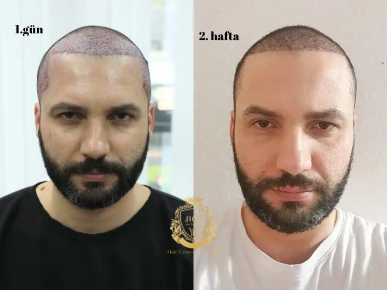 Saç Ekimi Sonrası Kaç Gün Sırt Üstü Yatılır?