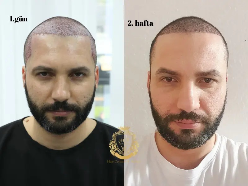 Saç Ekimi Sonrası Kaç Gün Sırt Üstü Yatılır?