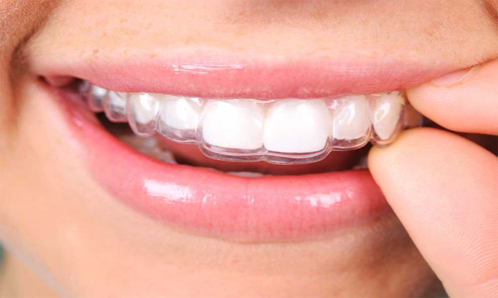 İnvisalign Tedavisi Kimler İçin Uygundur?