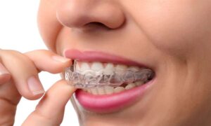 İnvisalign Tedavisi Nedir?
