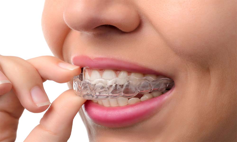 İnvisalign Tedavisi Nedir?